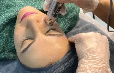 Mezoterapi Nedir ve Hangi Durumlarda Uygulanır?