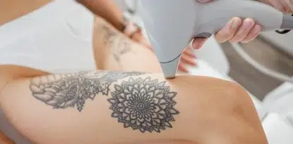 Lazer epilasyon dövmeye zarar verir mi?