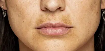Cilt Lekeleri Neden Olur? Nasıl Geçer?